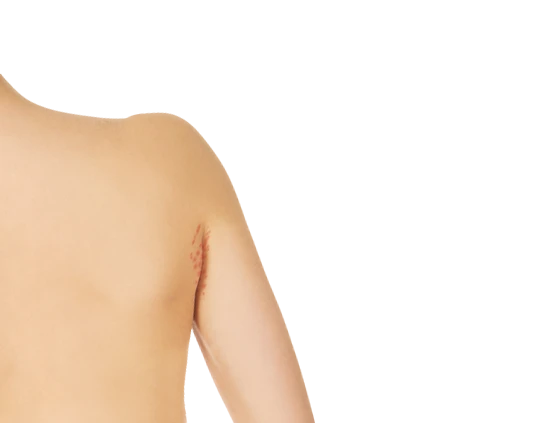 Achsel Rückenansicht einer Achsel mit rötlichen Stellen